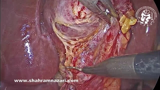 روش "برش نیمه " در مجرای سیستیک و دوشیدن سنگ مجرای کیسه در کوله سیستکتومی لاپاروسکوپی