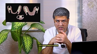 پروتز پارسیل؛ جایگزینی اقتصادی و متحرک برای دندان‌های از دست رفته