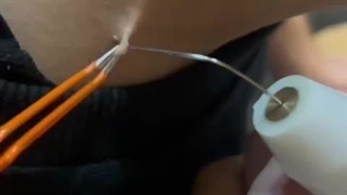 برداشتن ضایعات پوستی با دستگاه پزشکی Plasma Surgical