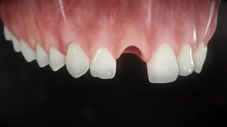 صفر تا صد ایمپلنت دندان