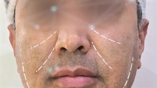 لیفت و جوانسازی صورت با نخ نامیکای اپتوس و فیلر الانسه رادیوگرافی دندان