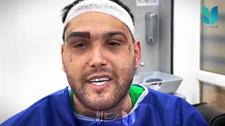 کاشت ابرو مردانه