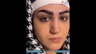 تفاوت را ببینید! قبل و بعد از کاشت ابرو