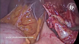 مدیریت سنگ(های) گیر افتاده در مجرای سیستیک در طی کوله‌سیستکتومی لاپاراسکوپی