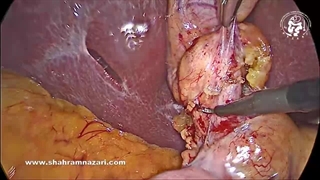 سندروم میریزی تیپ 1