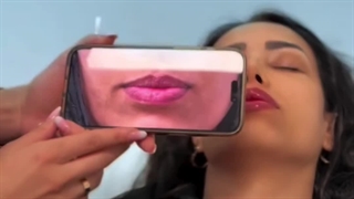 تزریق ژل لب در کلینیک گونه