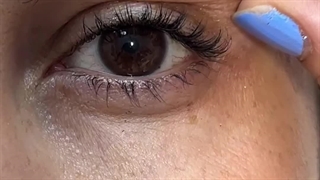 رضایت مراجعه کننده عزیزمون یک هفته بعد از بلفاروپلاستی پلک بالا