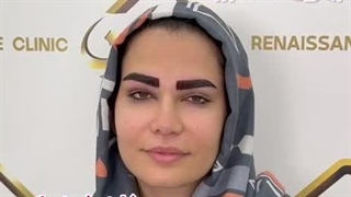 قبل و بعد از کاشت ابروی طبیعی