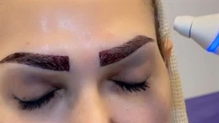 کاشت ابرو بدون جراحی به روش انحصاری sut
