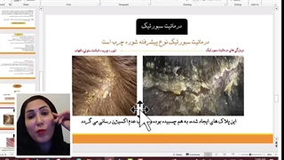 بیماری درماتیت سبورئیک