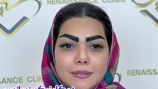 کاشت ابروی طبیعی در کلینیک زیبایی رنسانس