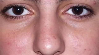 عمل زیبایی بینی در تهران.