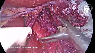 آنتی ریفلاکس با دور فوندوپلیکاسیون  3 بخیه ای در آشالازی