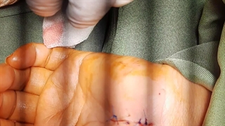 جراحی سندروم کارپاتونل