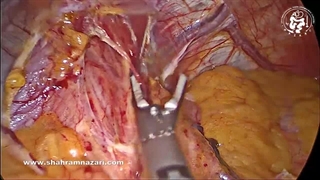 میوتومی هلر لاپاراسکوپی برای درمان آشالازی نوع 3