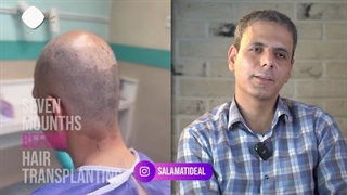 تجربه آقای سیدی 7 ماه بعد از کاشت مو