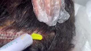 محل برداشت فلپ