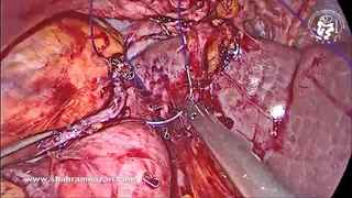 اسلیو مجدد در چاقی مجدد بدنبال اسلیو معده