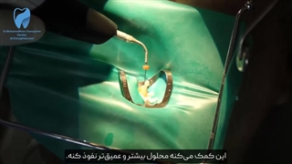 مراحل عصب کشی دندان