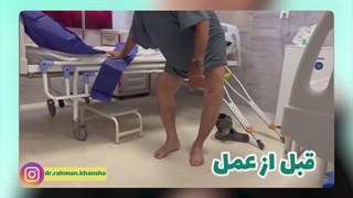 نادرترین عمل‌های جراحی تعویض مفصل زانو