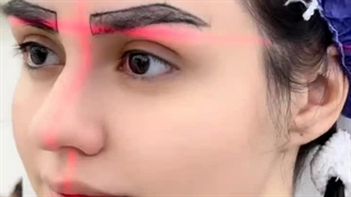 به روزترین روش کاشت مو و ابرودر ایران با لیزر