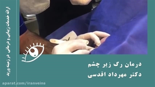 واریس زیر چشم