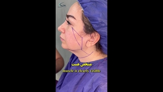 سوپر لیفت صورت و گردن به روش دیپ پلین