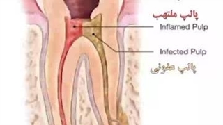 علت پوسیدگی دندان