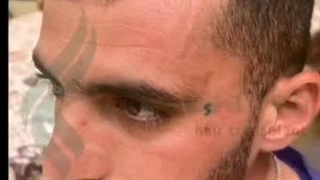 کاشت مو مینا وزیرزاده در شیراز