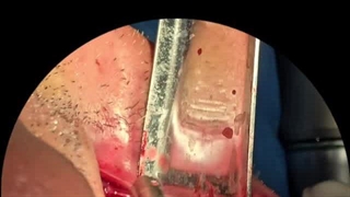 کاشت دندان تخصصی در میدان حر تهران مطب دکتر پورصادقی