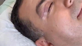 جوانسازی چشم با روش جدید بلفالیفت