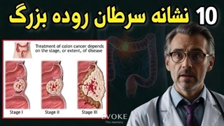 ۱۰ نشانه اولیه سرطان روده بزرگ که بدون درد شروع می‌شن (بیشتر آدما متوجه نمی‌شن)