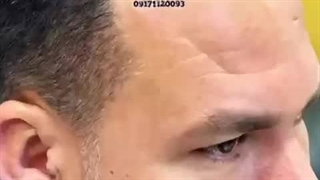 کاشت مو سمیه فلاح در شیراز