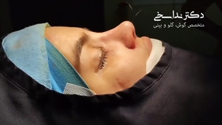 بلافاصله پس از عمل بینی