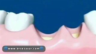 پودر استخوان برای ایمپلنت
