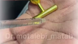 درمان تعریق کف دست با بوتاکس | روشی برای کاهش تعریق بیش از حد