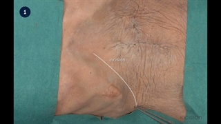 4 Abdominal Wall Incision - Kocher