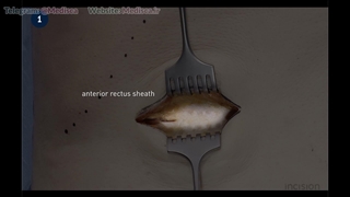 8 Abdominal Wall Incision - Mini Transverse