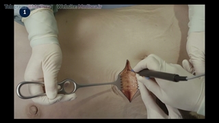 11 Abdominal Wall Incision - Transverse Right
