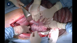 13 Trauma Laparotomy Penetrating Right Upper Quadrant Injury