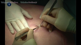 14 Trocars - Abdominal Open Introduction