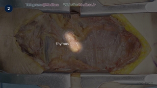 1 Open Thymectomy