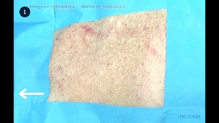 7 Limberg Flap