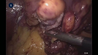 8 Bowel Anastomosis - Circular Stapler (Laparoscopic)