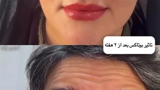 تاثیر بوتاکس بعد از 2 هفته