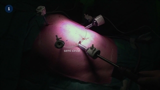 22_1 Laparoscopic Multivisceral Distal Pancreatosplenectomy - Neoplastic