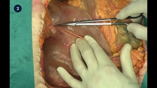 50 Open Right Hepatectomy