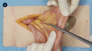 55 Open Small Intestine Resection