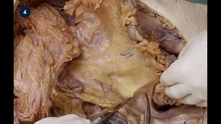 57 Open Total Mesorectal Excision