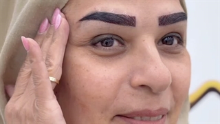 ابروهای مرتب و پر با کاشت ابرودر کلینیک سینا همان رنسانس معروف